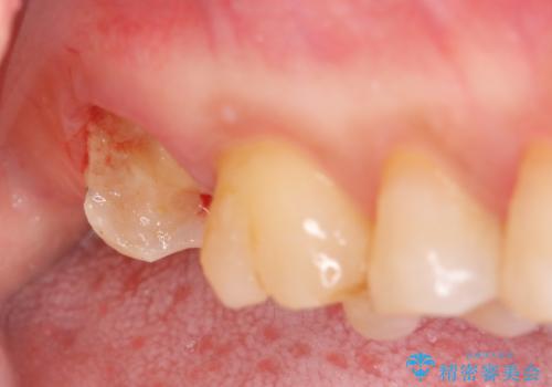 歯髄方向 歯肉方向へと深い 2種類の大きな虫歯の治療中