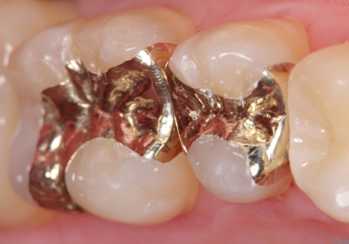 保険適応の白い詰め物レジンインレー下に再発した大きな虫歯治療の治療後