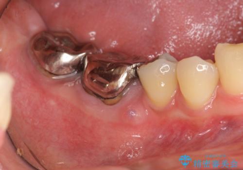 歯ぐきの腫れが治らない 石灰化した狭小根管治療の治療前