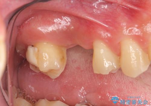 ソケットリフトを伴うインプラント補綴 の症例 治療前
