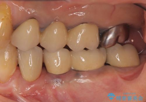 ブリッジ支台の歯の痛み インプラントによる咬合負担の治療後