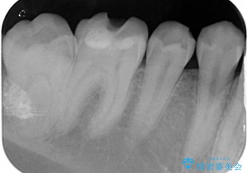 セラミックインレーやりかえ 虫歯の除去をしっかりとの治療前