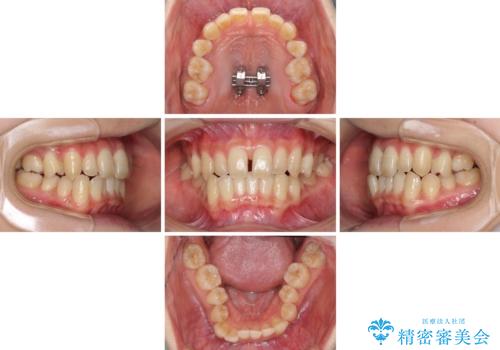 奥歯の反対咬合 上顎骨を拡大してインビザラインで矯正の治療中