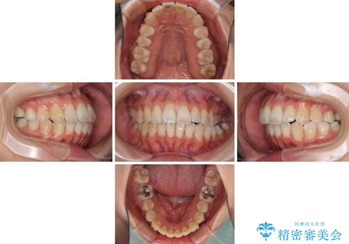 インビザラインで機能面に問題のある歯列を改善の治療中