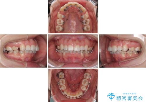 目立たない裏側矯正 抜歯矯正で口元を改善の治療中