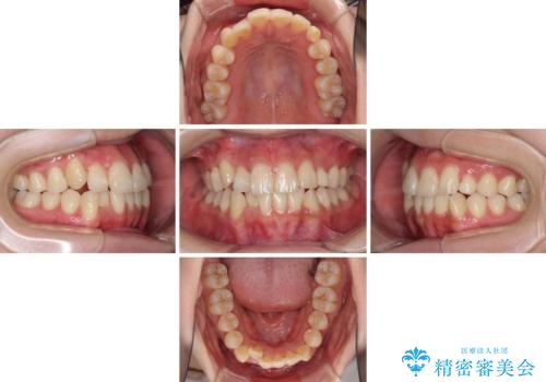 インビザライン矯正とインプラント治療と 総合歯科治療の治療中