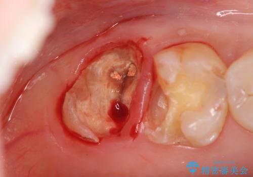 歯髄方向　歯肉方向へと深い 2種類の大きな虫歯の治療中