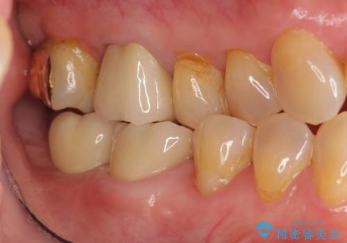 奥歯　インプラントによる機能回復の治療後
