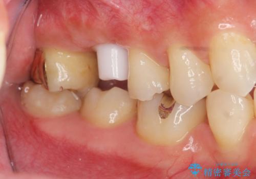 ソケットリフトを伴うインプラント補綴 の治療中