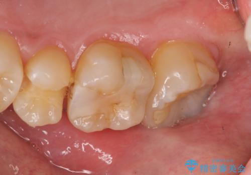窩洞形態により選択するインレーの素材の治療前