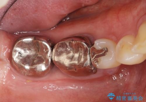 歯ぐきの腫れが治らない 石灰化した狭小根管治療の治療前