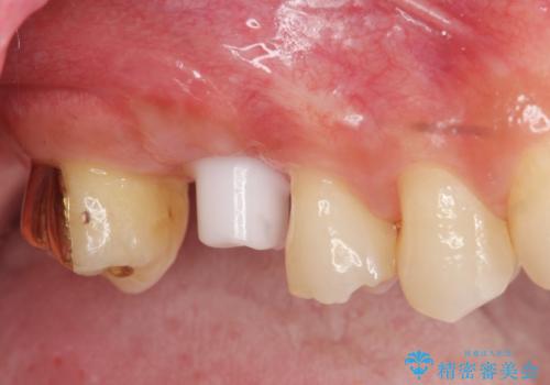 ソケットリフトを伴うインプラント補綴 の治療中