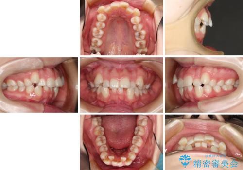 目立たない裏側矯正 抜歯矯正で口元を改善の治療前