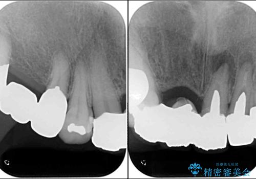 着色が著しい前歯のブリッジをオールセラミックできれいにの治療前