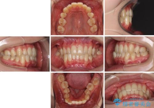 奥歯の反対咬合 上顎骨を拡大してインビザラインで矯正の治療前