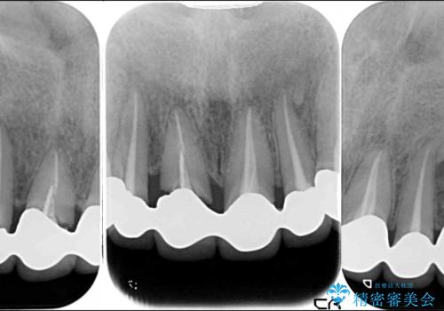 深い虫歯と不自然な色調の前歯 オールセラミッククラウンで自然にの治療前