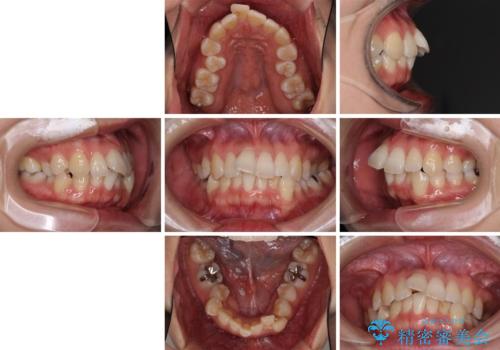 インビザラインで機能面に問題のある歯列を改善の治療前