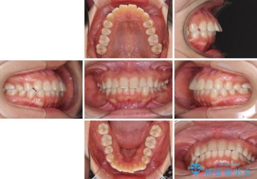 インビザラインによる軽度な出っ歯の矯正治療の治療前