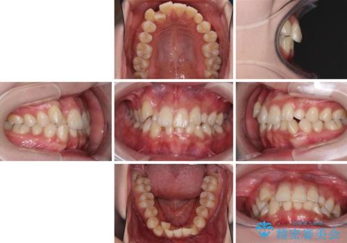 インビザライン矯正とインプラント治療と 総合歯科治療の治療前