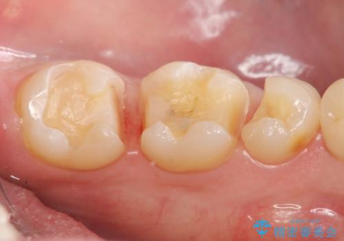 保険適応の白い詰め物レジンインレー下に再発した大きな虫歯治療の治療中