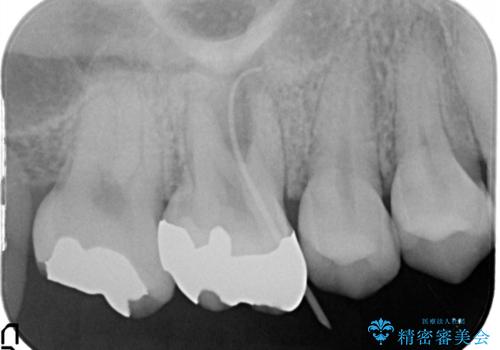歯茎がはれてきた 根の治療をしてからのセラミック装着の治療前