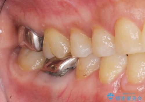 歯髄方向 歯肉方向へと深い 2種類の大きな虫歯の治療前