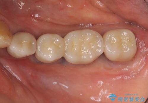 ブリッジ支台の歯の痛み インプラントによる咬合負担の治療後