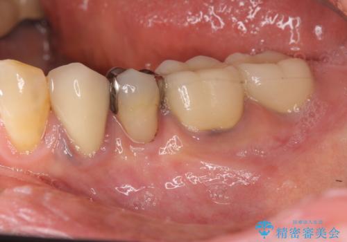 ブリッジ支台の歯の痛み　インプラントによる咬合負担の症例 治療前