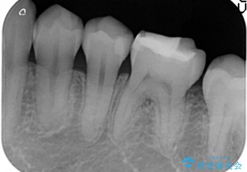 プレスセラミックインレー。精度にこだわるの治療後