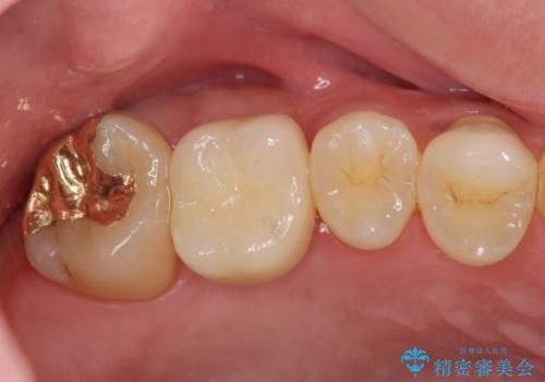ソケットリフトを伴うインプラント補綴 の治療後