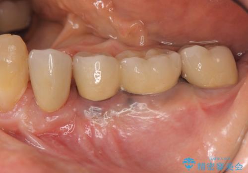 ブリッジ支台の歯の痛み インプラントによる咬合負担の症例 治療後