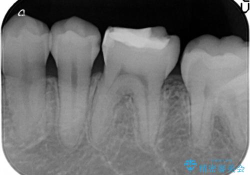 プレスセラミックインレー。精度にこだわるの治療前