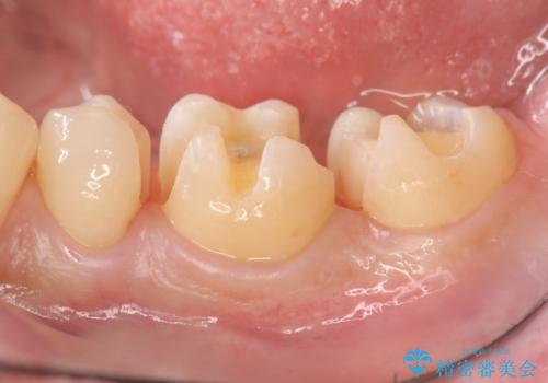 保険適応の白い詰め物レジンインレー下に再発した大きな虫歯治療の治療中