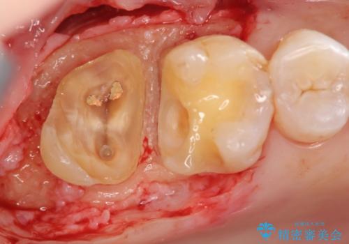 歯髄方向 歯肉方向へと深い 2種類の大きな虫歯の治療後