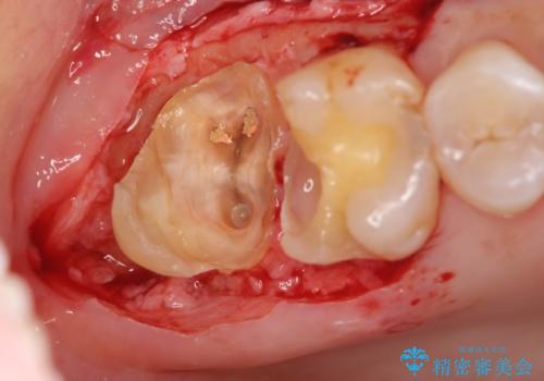 歯髄方向 歯肉方向へと深い 2種類の大きな虫歯の治療中