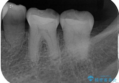 奥歯の被せ物をしたい。しみる奥歯、アイスを食べたい。の治療前