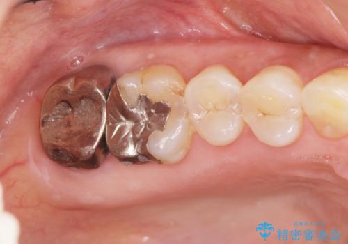 歯髄方向 歯肉方向へと深い 2種類の大きな虫歯の治療前