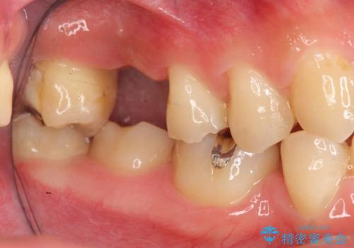 ソケットリフトを伴うインプラント補綴 の治療前