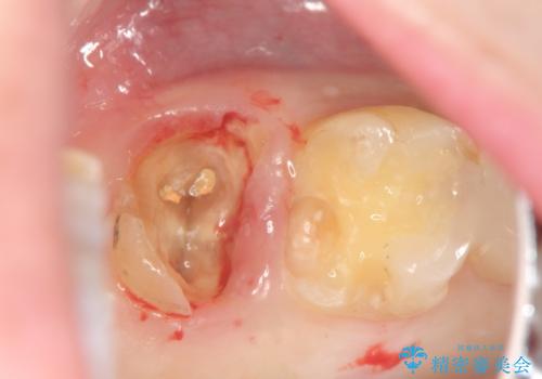 歯髄方向 歯肉方向へと深い 2種類の大きな虫歯の治療前