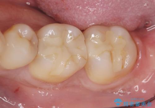 保険適応の白い詰め物レジンインレー下に再発した大きな虫歯治療の症例 治療前