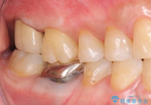 歯髄方向 歯肉方向へと深い 2種類の大きな虫歯の治療後