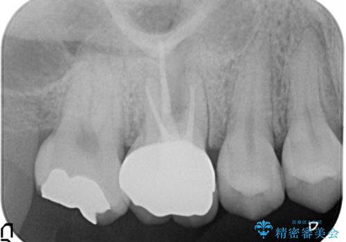歯茎がはれてきた 根の治療をしてからのセラミック装着の治療後