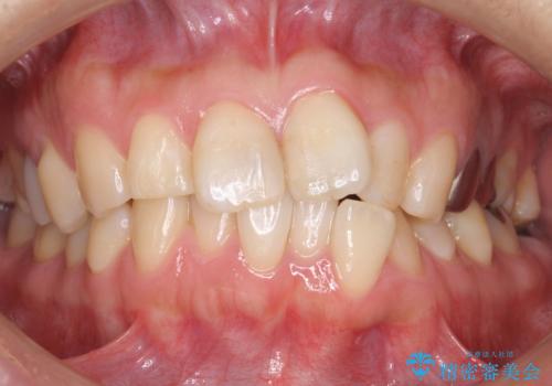 前歯の歯並びが気になる　マウスピース矯正　30代女性の治療前
