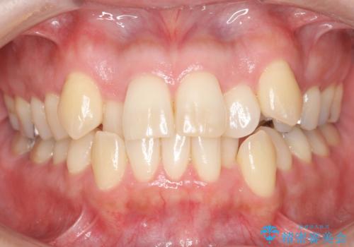 40代の矯正　八重歯を綺麗に　の症例 治療前