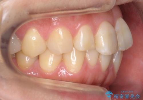 前歯の歯並びが気になる マウスピース矯正 30代女性の治療前