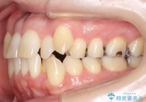 40代の矯正 八重歯を綺麗に の治療前