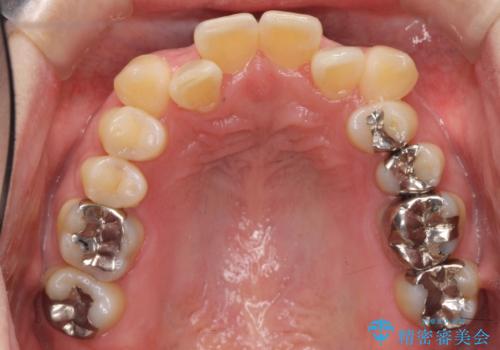 40代の矯正 八重歯を綺麗に の治療前
