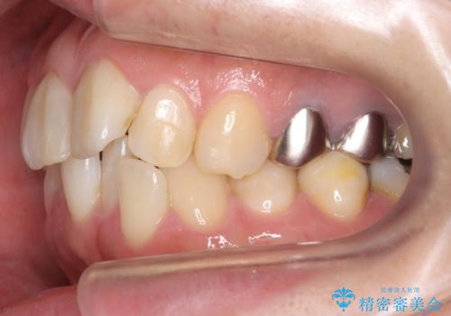 前歯の歯並びが気になる マウスピース矯正 30代女性の治療前