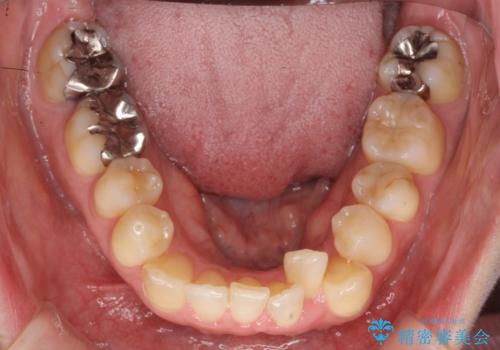 40代の矯正　八重歯を綺麗に　の治療前