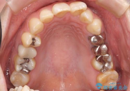 前歯の歯並びが気になる マウスピース矯正 30代女性の治療前